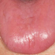 Atrophic Glossitis