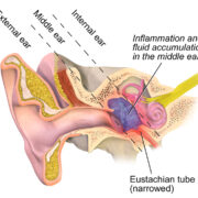 Orta Kulakta Sıvı Birikmesi