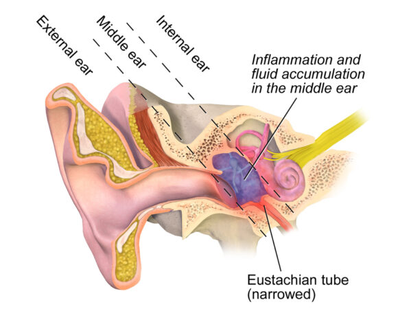 Orta Kulakta Sıvı Birikmesi